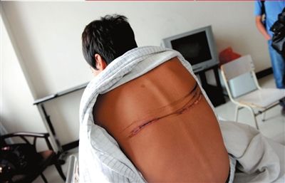 一名伤者背部至今还有明显的伤疤。